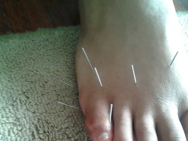 Imaging Tests for Nerves in the Foot and Ankle Region: Neurography