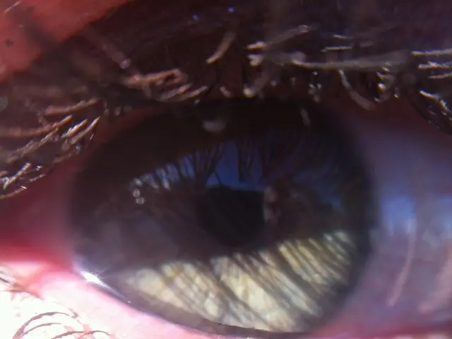 Dry Eye Treatment Through Light Therapy: Mechanism, Safety, and Insights